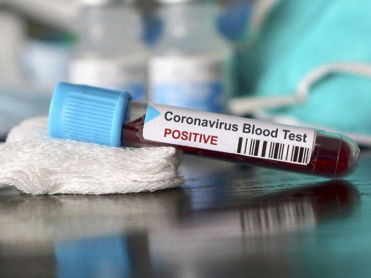 Azərbaycanda 387 nəfər koronavirusa yoluxdu - Ölənlər var -