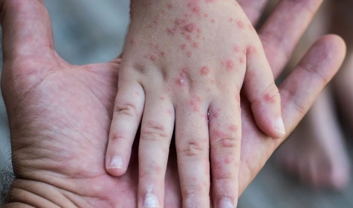 Allergiyalı uşaqlar qızılcaya qarşı peyvənd oluna bilər? -