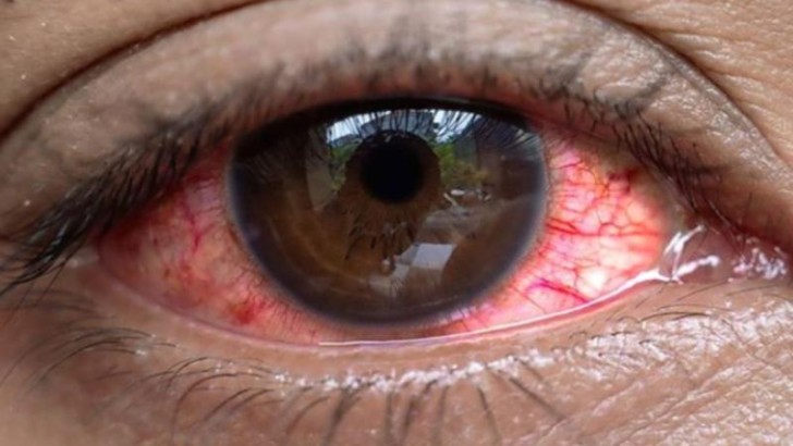 Uqandada "qırmızı göz" xəstəliyi - Yoluxanların sayı 7500-ü keçdi