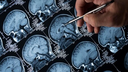 Probiyotiklər Alzheimer xəstəliyinin erkən əlamətlərinə qarşı faydalı ola bilər
